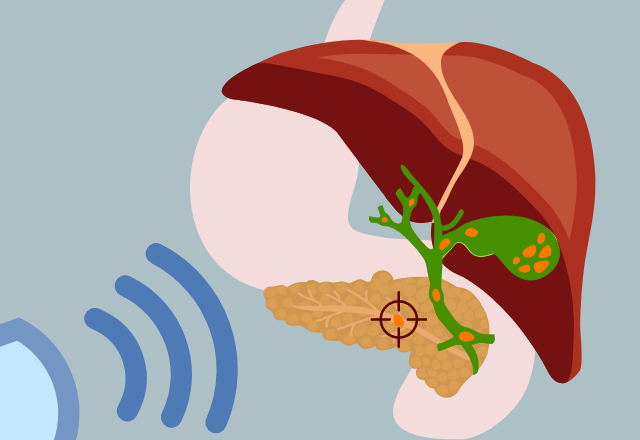Illustration of shock waves aimed at a pancreatic stone