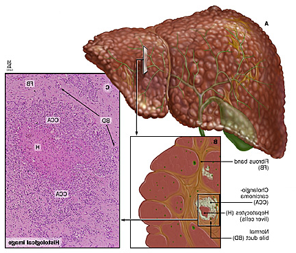 A: Cholangiocarcinoma within a cirrhotic liver; B: cross-section of tumor; C: histological imaging showing tumor cells surrounding normal hepatocytes. 