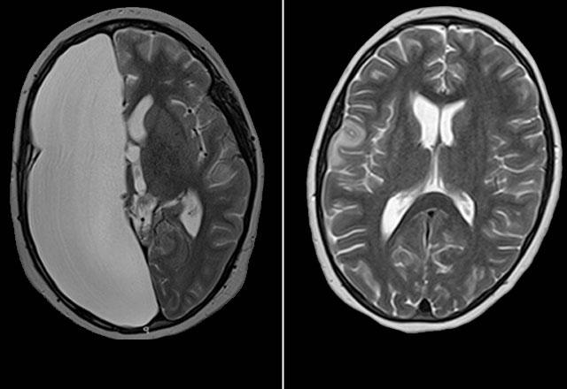 治疗前后脑MRI
