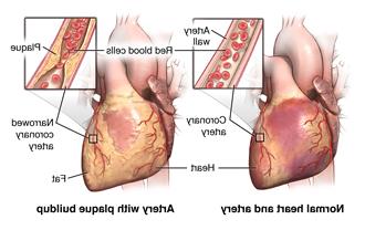 正常的心脏和动脉，以及动脉壁上的斑块